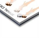 Spinal deformity types Acrylic print