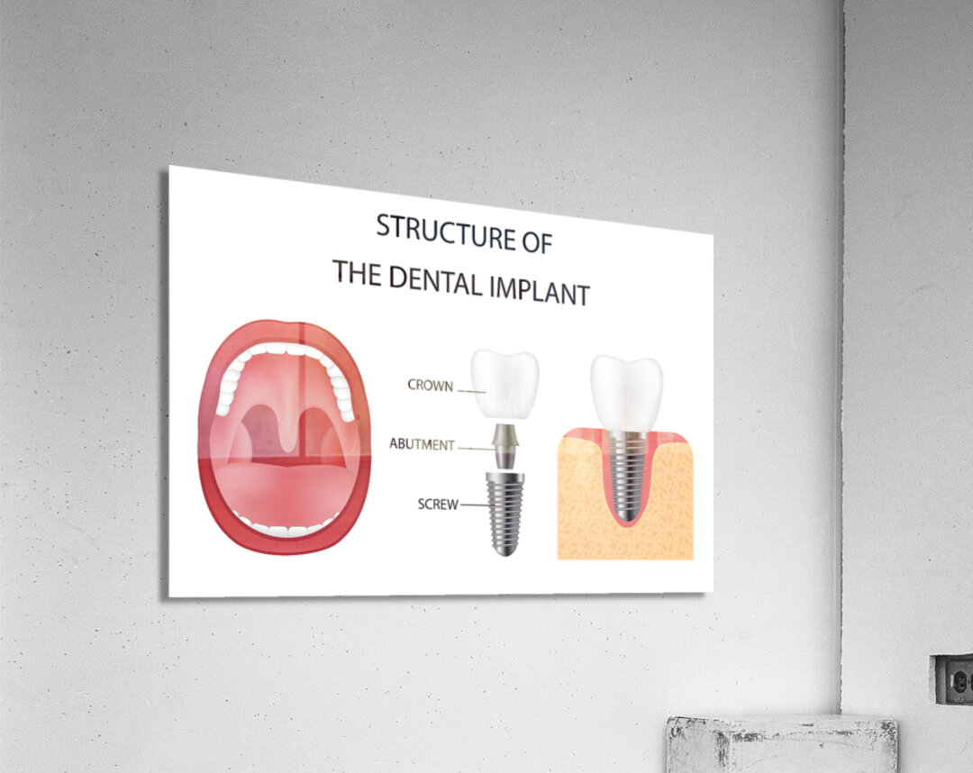 Dental implant structure Acrylic Print