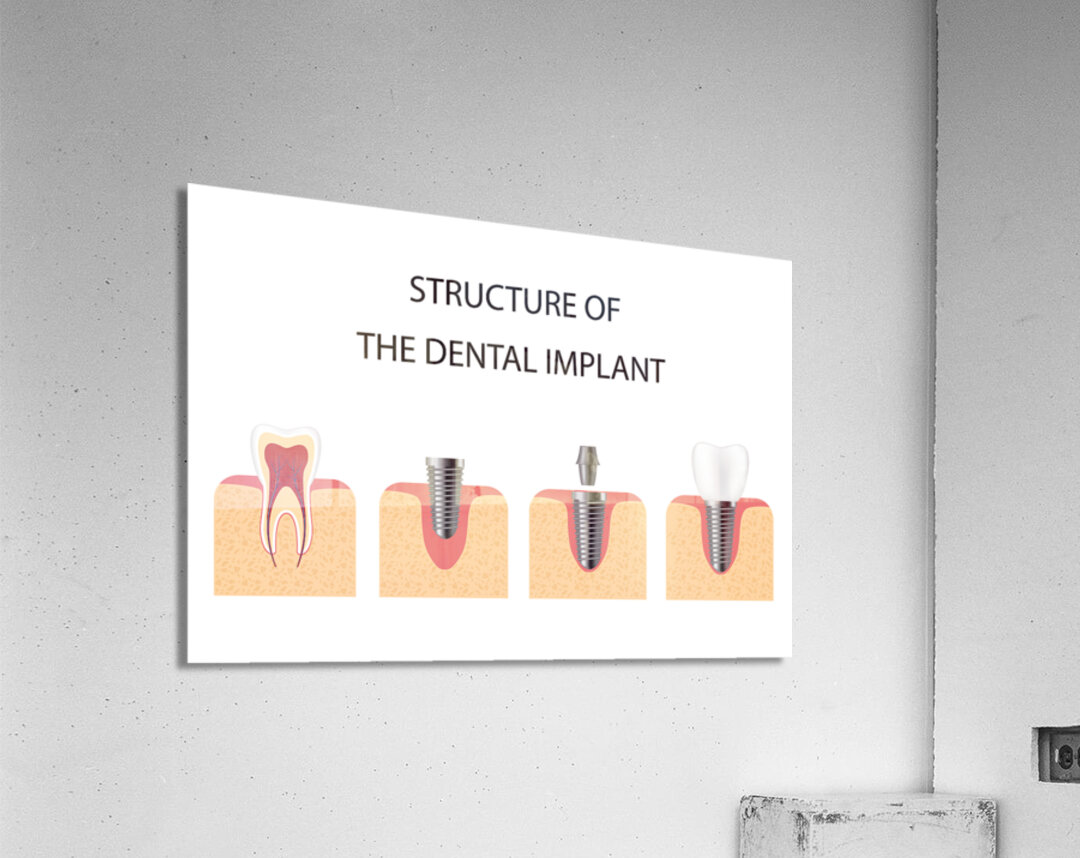 Structure of the dental implant Acrylic Print