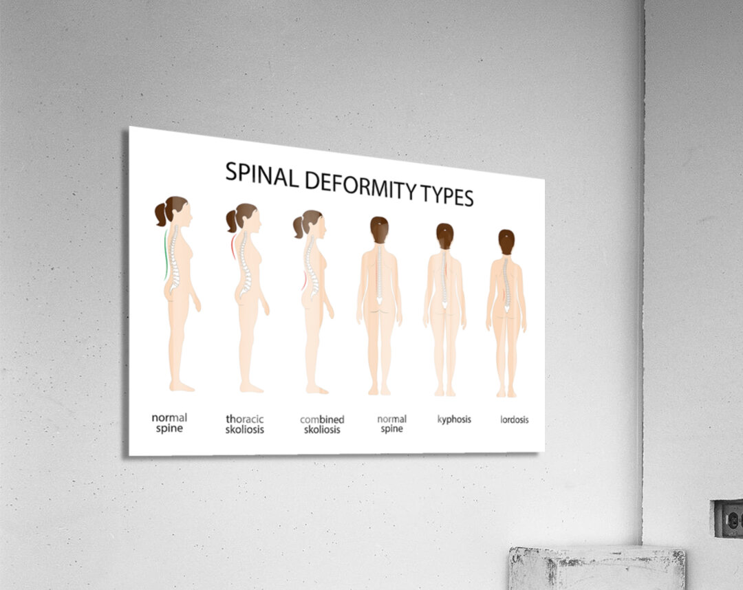 Spinal deformity types Acrylic Print