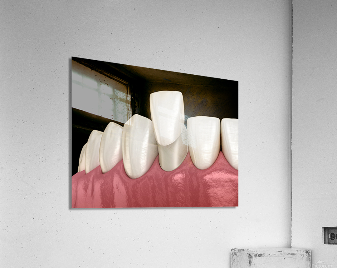 Veneer placement procedure 3D illustration Acrylic Print