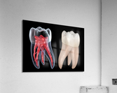 Dental root anatomy - First maxillary molar tooth  Acrylic Print