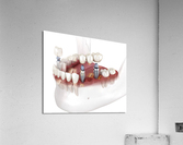 Dental bridge and crown placement over implants Acrylic Print