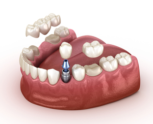 Tooth recovery with implant and crown 3d illustration