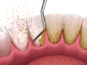 Oral hygiene: Scaling and root planing conventional periodontal therapy