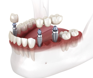 Dental bridge and crown placement over implants