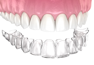 Healthy teeth and invisible retainer