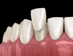 Veneer placement procedure 3D illustration
