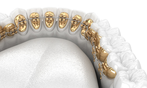 Healthy Teeth with gold braces white style concept dental 3D illustration