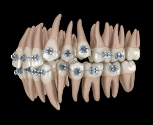Abnormal teeth position and metal braces tretament