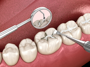 Molar tooth fissure restoration with filling. Medically accurate tooth 3D illustration.