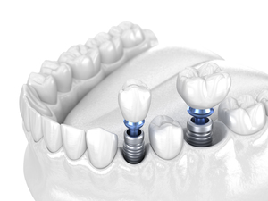 Premolar and Molar tooth crown installation over implant - white concept