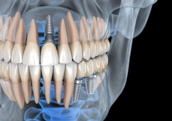 Teeth recovery with implants x-ray view. Print