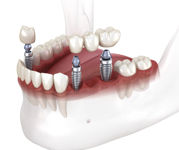 Dental bridge and crown placement over implants Print