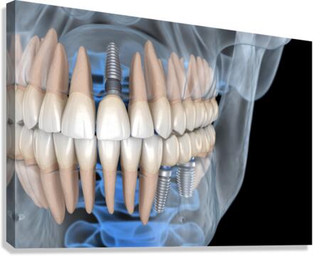 Teeth recovery with implants x-ray view. Canvas Print