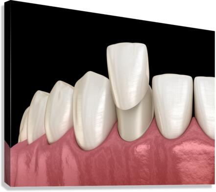 Veneer placement procedure 3D illustration Canvas Print