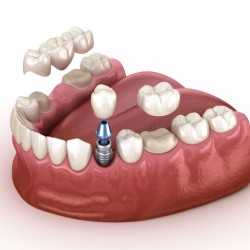 Tooth recovery with implant and crown 3d illustration