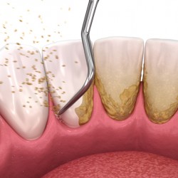 Oral hygiene: Scaling and root planing conventional periodontal therapy