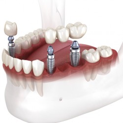 Dental bridge and crown placement over implants