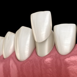 Veneer placement procedure 3D illustration