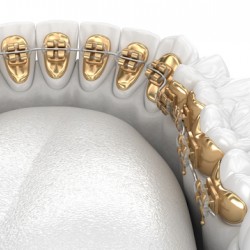 Healthy Teeth with gold braces white style concept dental 3D illustration