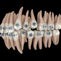 Abnormal teeth position and metal braces tretament