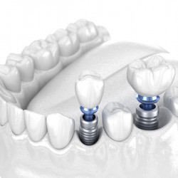 Premolar and Molar tooth crown installation over implant - white concept