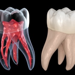 Dental root anatomy - First maxillary molar tooth