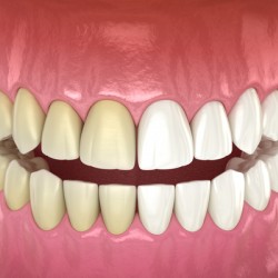Teeth whitening - before and after. Dental concept