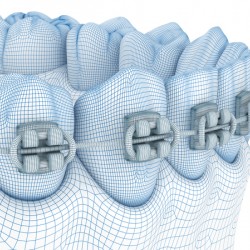 Braces and denture. Wire 3d model illustration