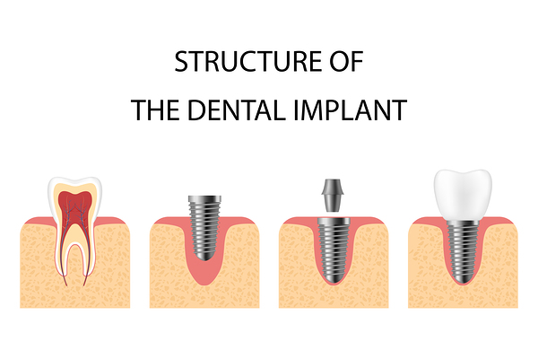 Structure of the dental implant Print