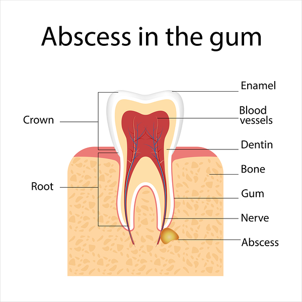 Abscess in the gum by Point Art