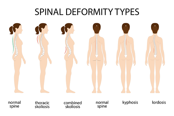 Spinal deformity types Print