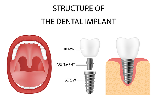 Dental implant structure Print
