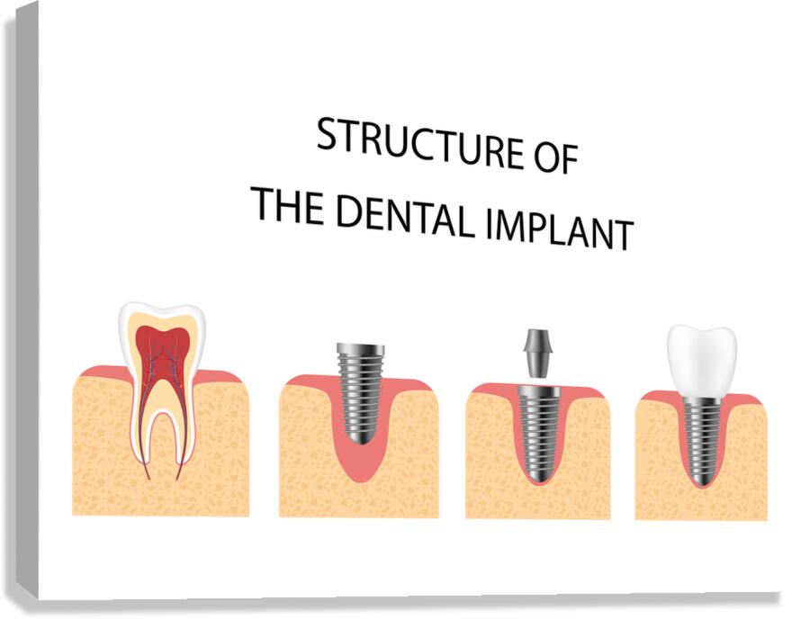 Structure of the dental implant Canvas Print