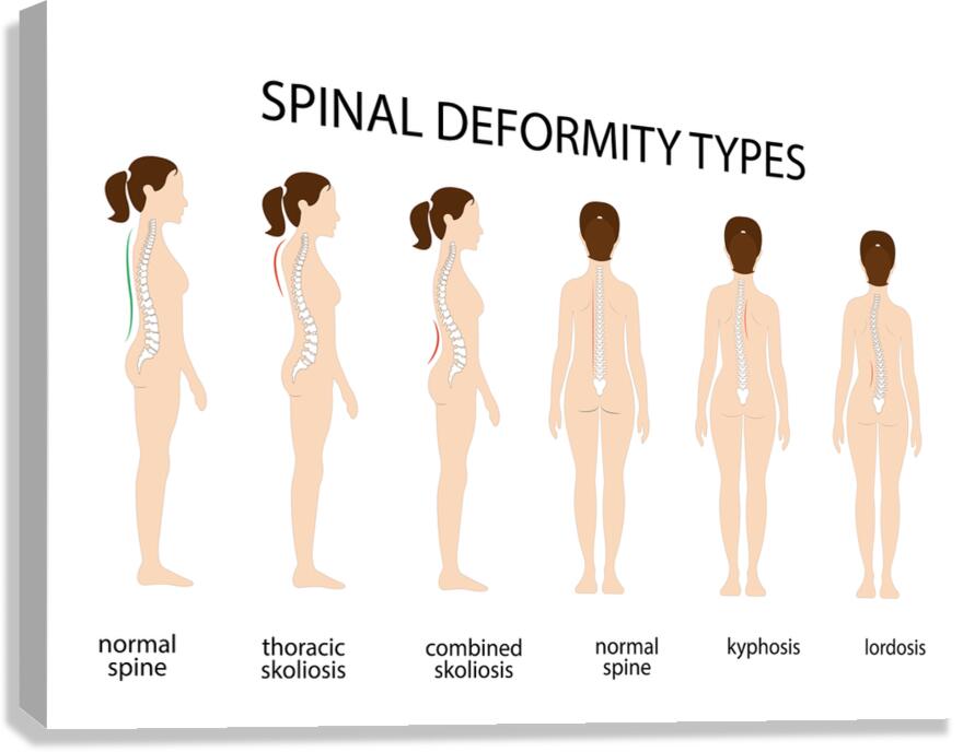 Spinal deformity types Canvas Print