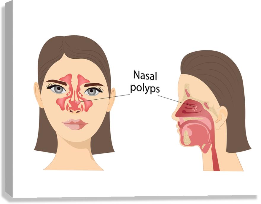 Nasal polyps Canvas Print