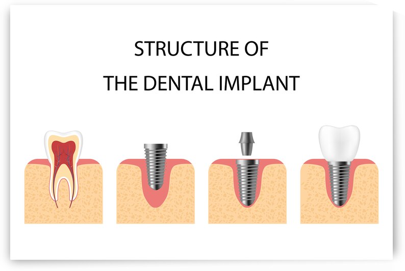 Structure of the dental implant by Point Art