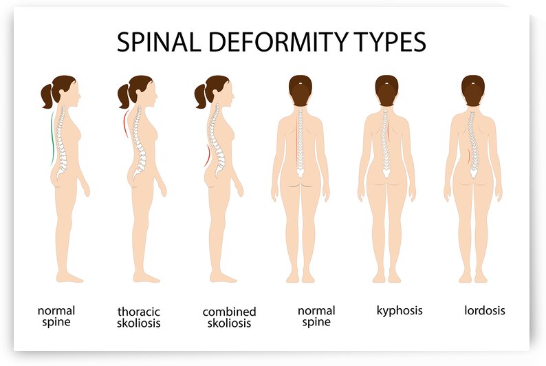 Spinal deformity types by Point Art