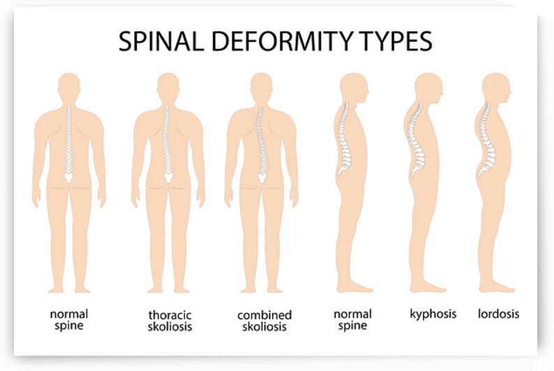 Anatomy of Spine deformity by Towseef Dar