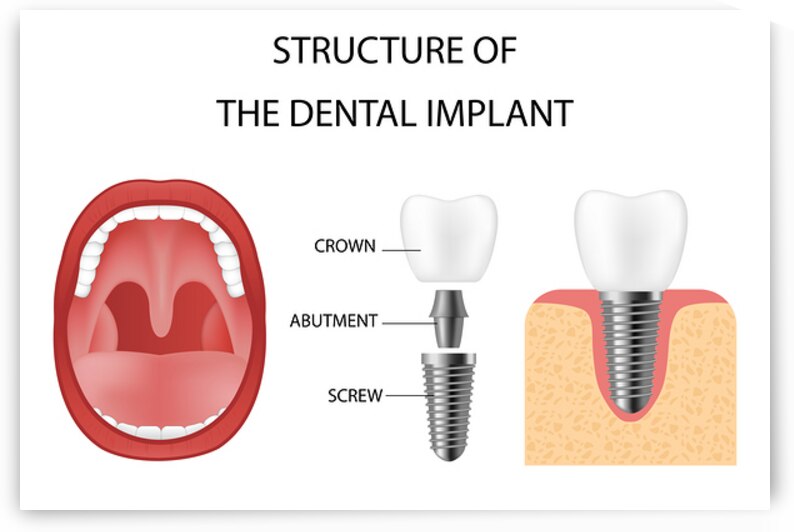 Dental implant structure by Towseef Dar