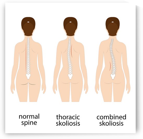 Spinal deformity by Towseef Dar