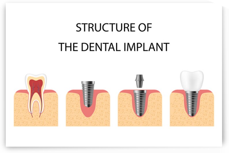 Structure of the dental implant by Towseef Dar