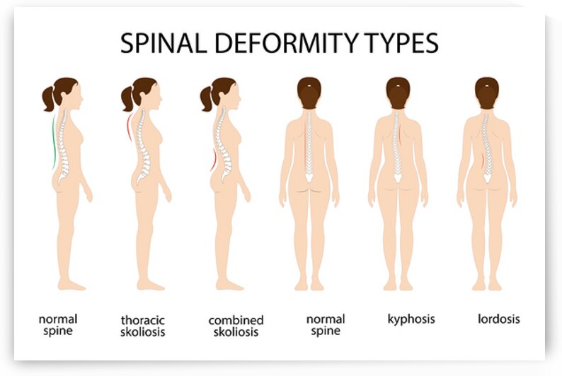 Spinal deformity types by Towseef Dar