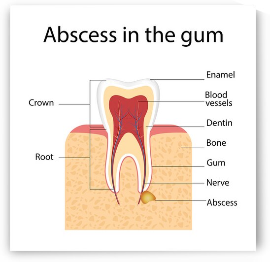 Abscess in the gum by Towseef Dar