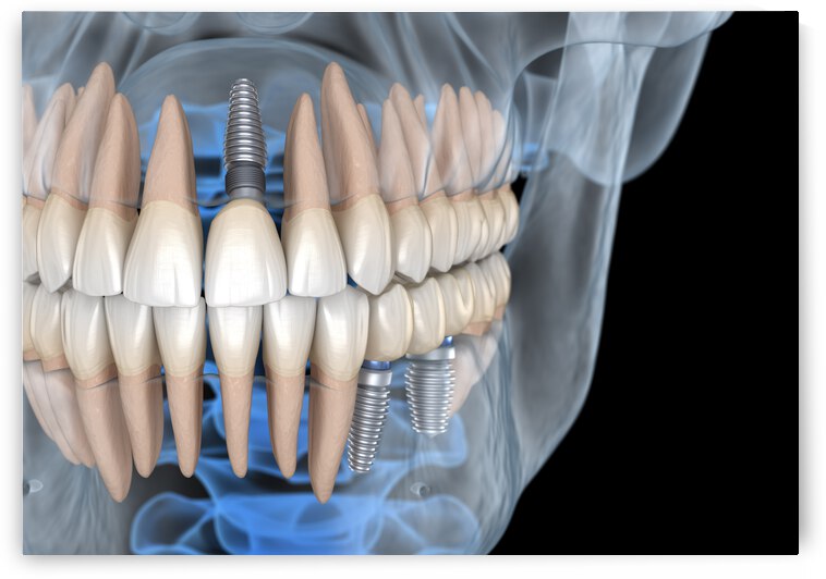 Teeth recovery with implants x-ray view. by Alex Mit