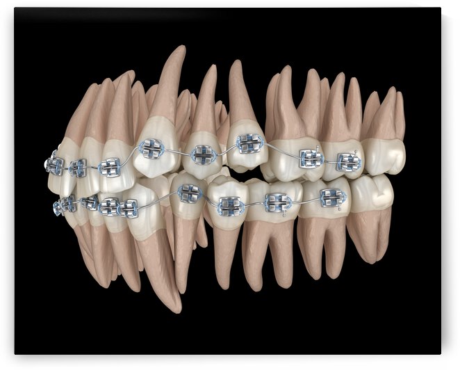 Abnormal teeth position and metal braces tretament by Alex Mit