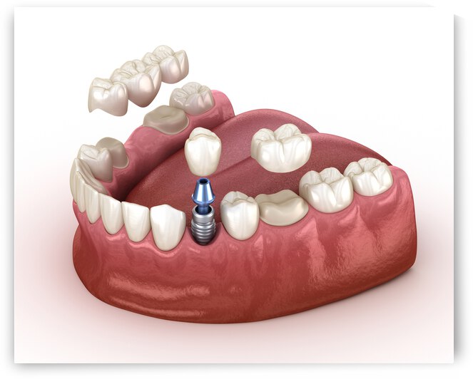 Tooth recovery with implant and crown 3d illustration by Alex Mit