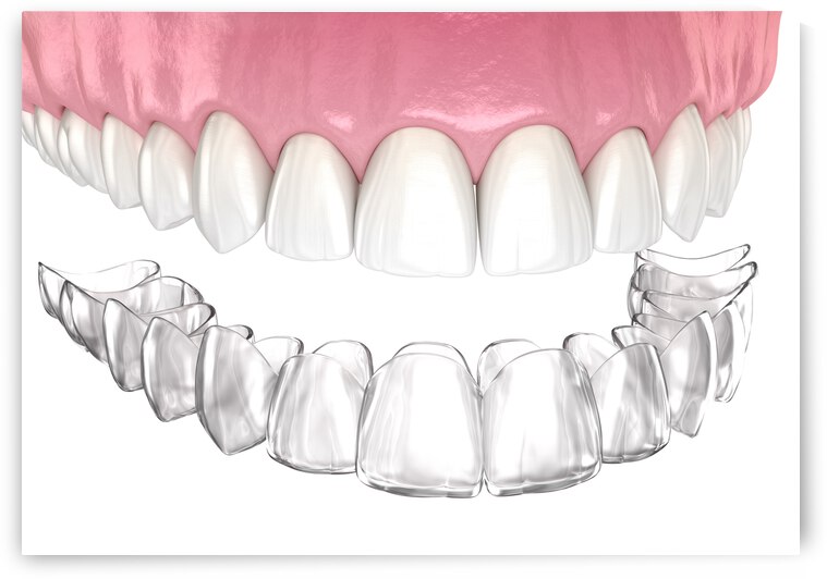 Healthy teeth and invisible retainer by Alex Mit