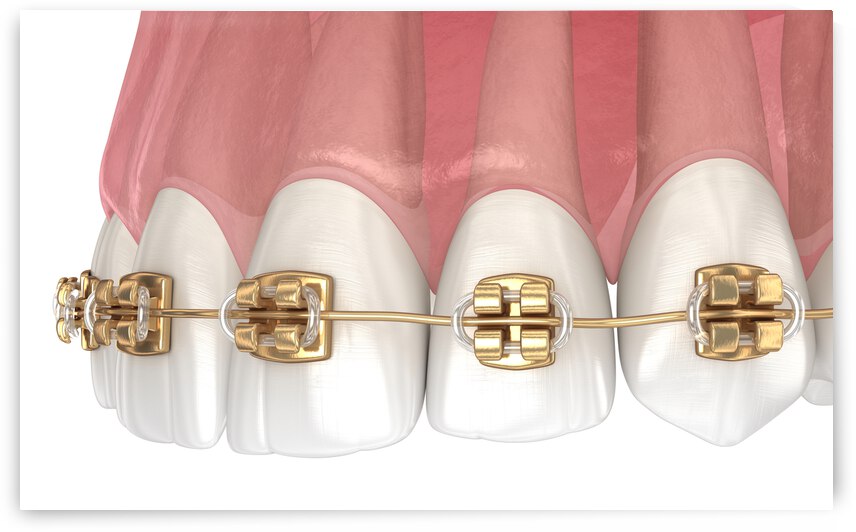 Golden braces tretament macro view by Alex Mit